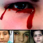 هيمولاكريا : دموع الدم