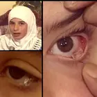 دموع الكريستال: القصة الكاملة لفتاة حيرت الأطباء