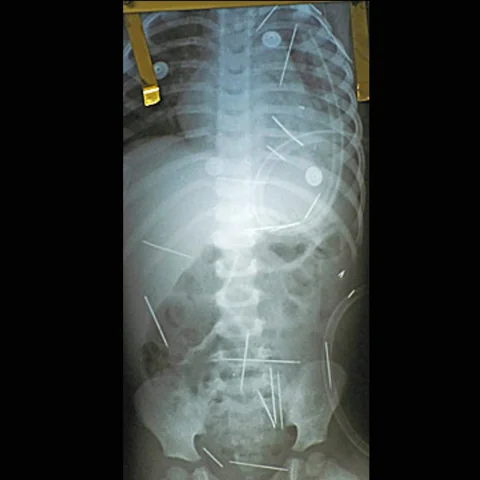 40 إبرة في طفل جراء طقس من السحر الأسود