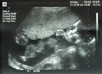 صورة للطفيلي الذي كان ينمو  على جدارن الرحم والذي يمتص المغذيات